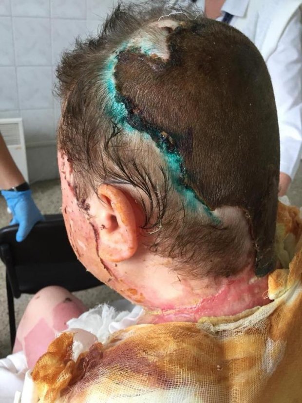 Вперше показали тіло Катерини Гандзюк після того, як її облили кислотою: фото (18+)