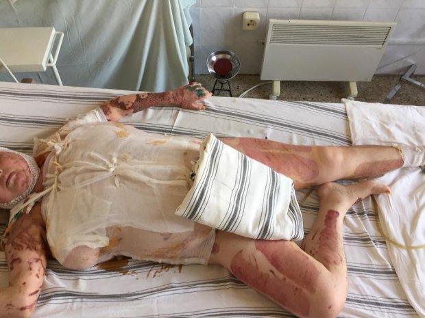 Вперше показали тіло Катерини Гандзюк після того, як її облили кислотою: фото (18+)